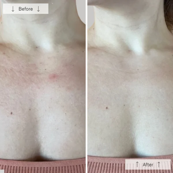 Omnilux Contour Neck and Décolleté - Image 5