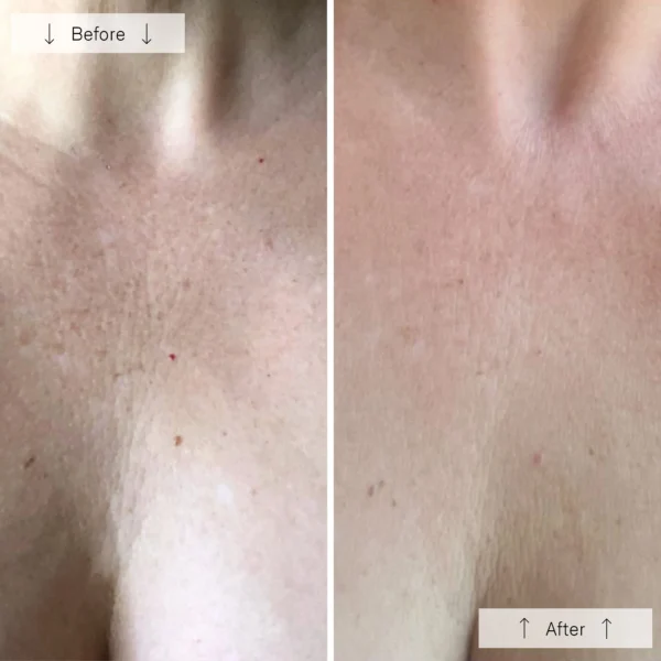 Omnilux Contour Neck and Décolleté - Image 6
